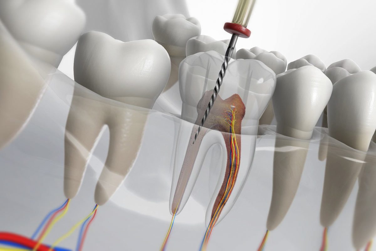 Root Canal Treatment Affordable Endodontic Treatments in Richmond Hill