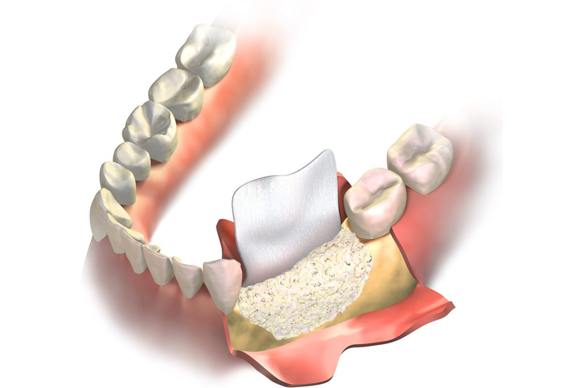 Periodontal Pockets Treatments Available for Periodontal Pockets in Richmond Hill
