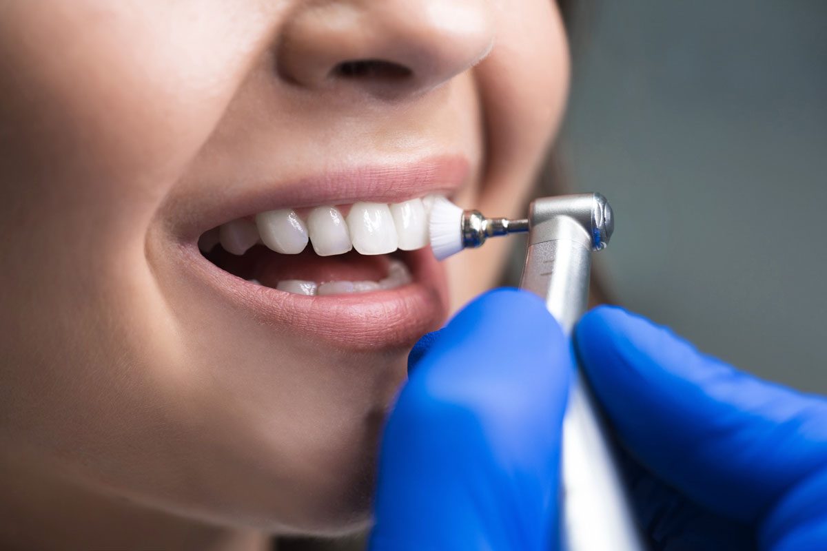 Dental Cleanings The Advantages of Regular Dental Cleanings