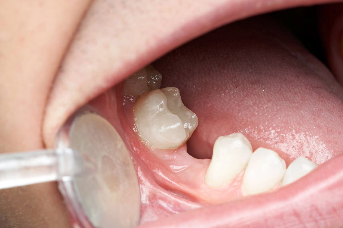 Pre-Prosthetic Surgery Surgical Treatment Options for Pre-Prosthetic Surgery