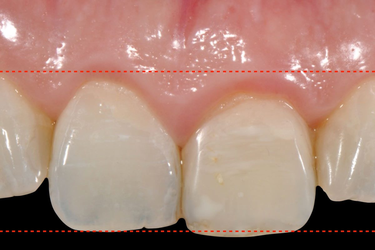Crown Lengthening Crown Lengthening Surgery in Richmond Hill