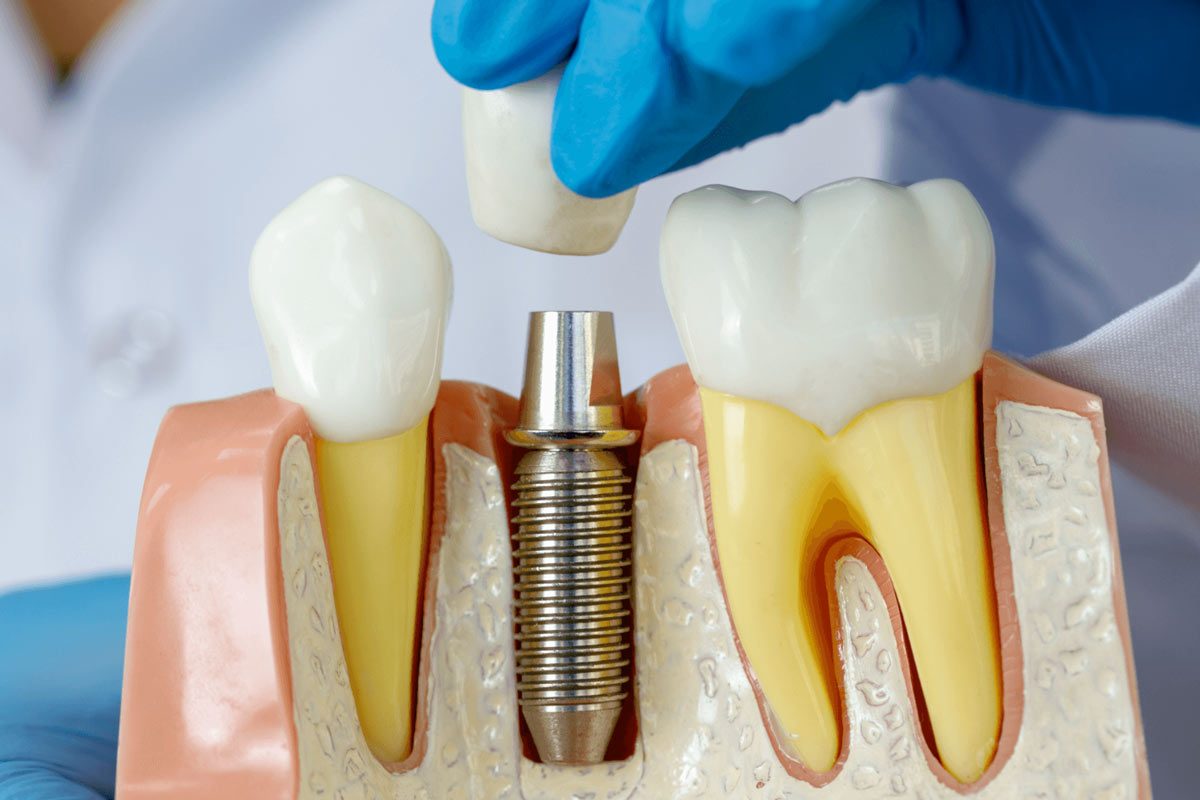 Dental Implants The Process of Same-Day Dental Implants
