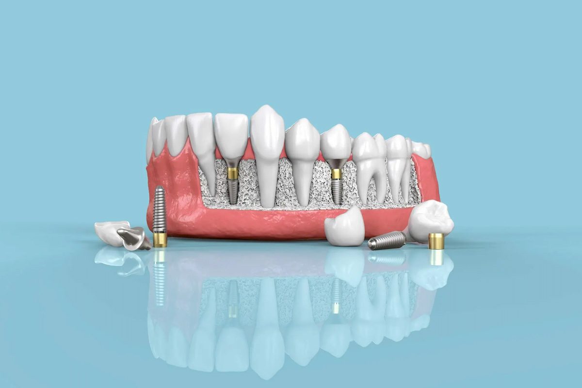 Dental Implants The Dental Implant-Retained Overdenture Process