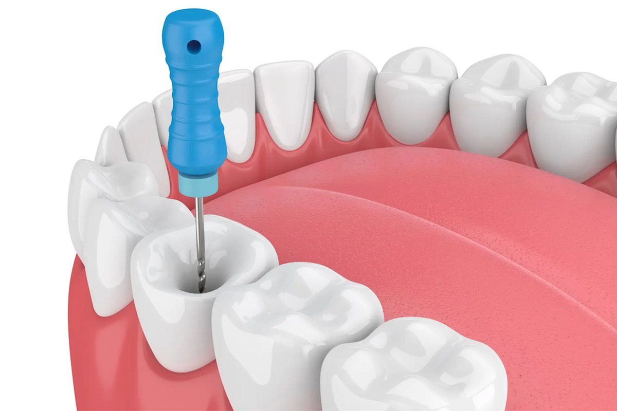 Root Canal Therapy Affordable Root Canal Therapy and Tooth Extraction in Richmond Hill, Ontario