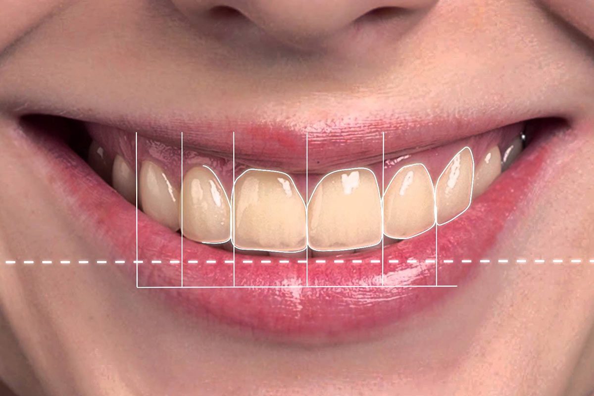 Digital Smile Design The Benefits of Digital Smile Design