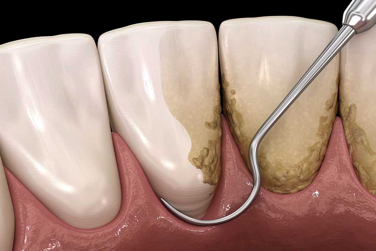 Scaling and Root Planing Exploring Non-Surgical Gum Disease Treatment Options