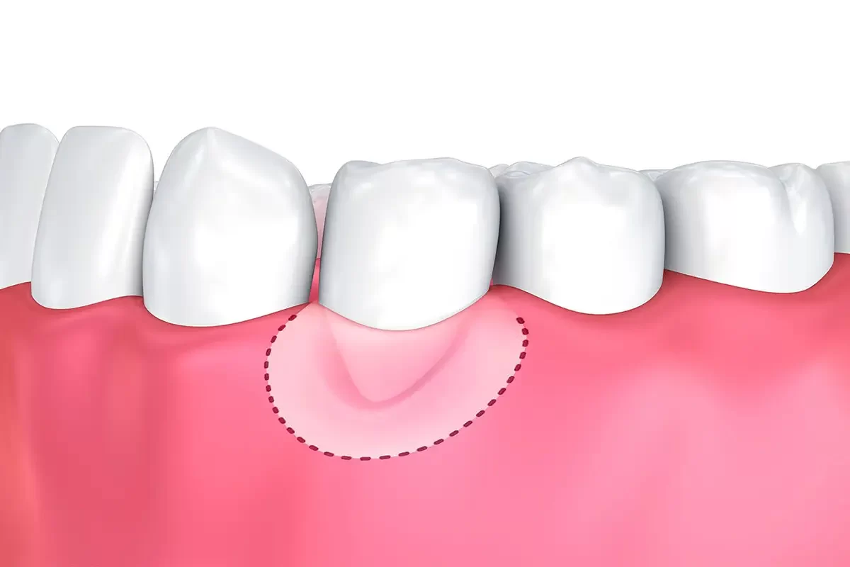 Gum Grafting The Benefits of Gum Grafting