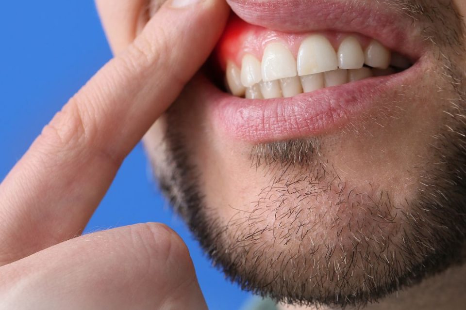 Periodontal Disease2 Periodontal Disease