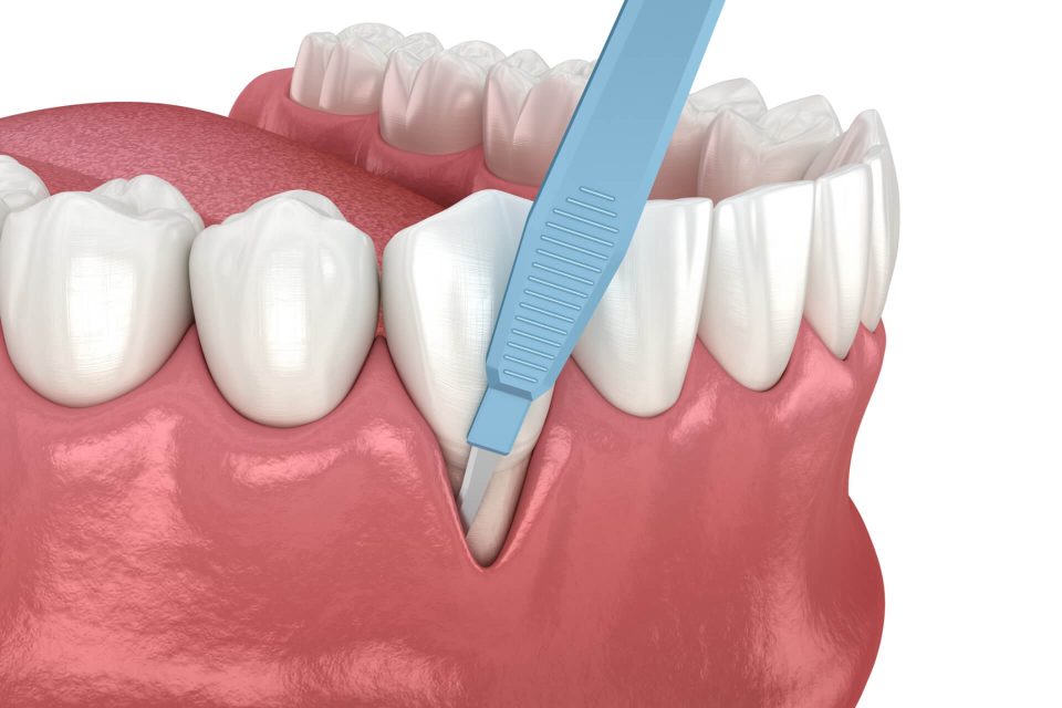 Periodontal-surgery Periodontal Surgeries