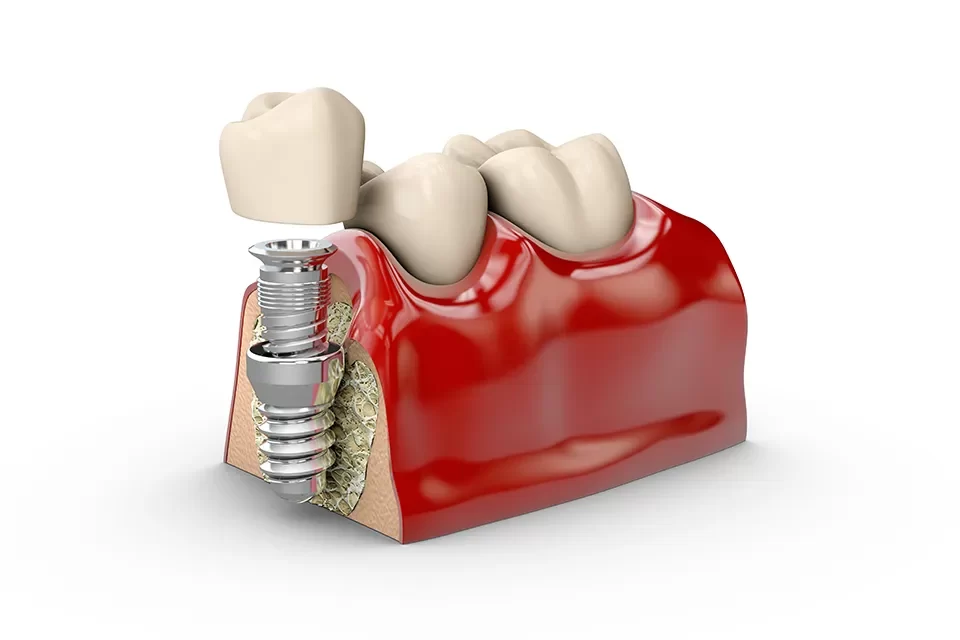 Dental Implants