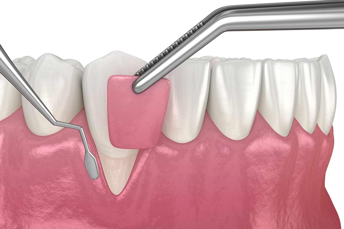 Understanding Gum Grafting Procedures at ORIS Dental Clinics in Richmond Hill, Ontario Understanding Gum Grafting Procedures at ORIS Dental Clinics in Richmond Hill, Ontario