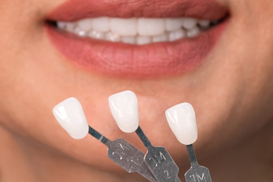 Untitled design (18) Dental Crowns vs. Veneers