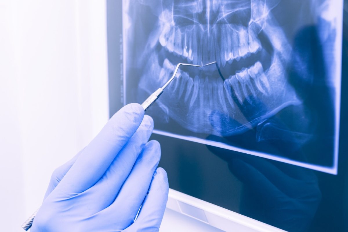 Types of Dental Crowns