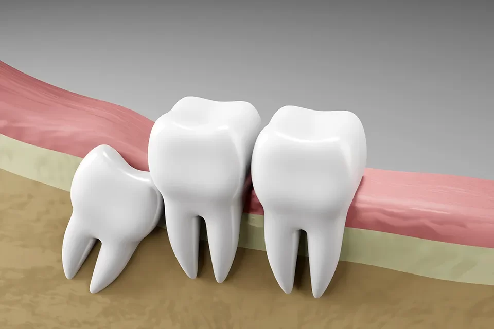 Wisdom Tooth Removal