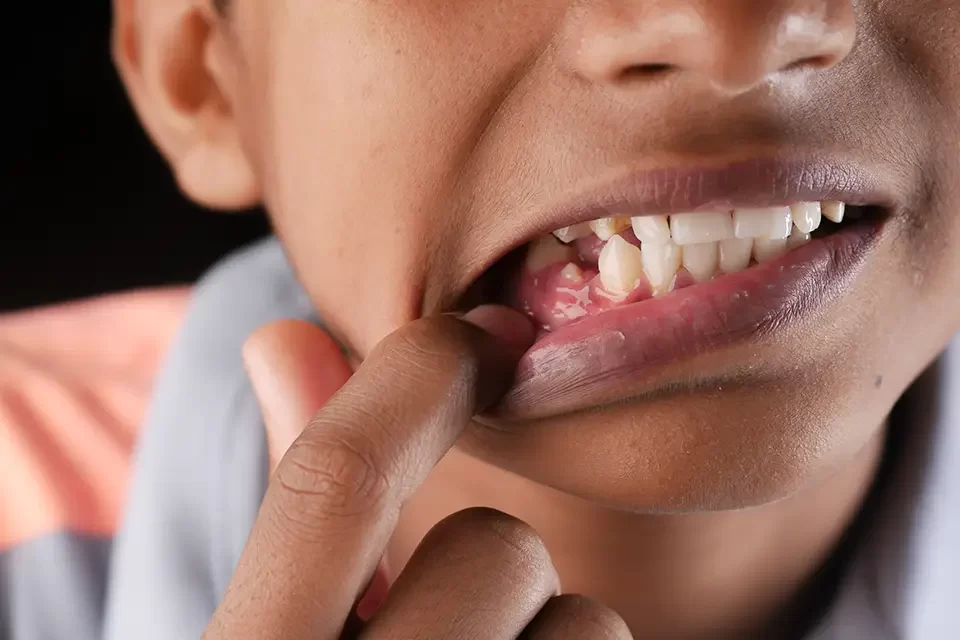 Treatment Path and Recovery Timelines for Signs of Gum Disease