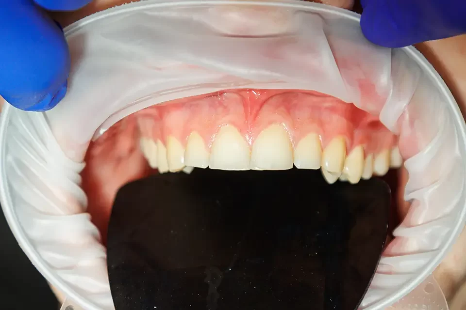 Considerations for Front Teeth Implants