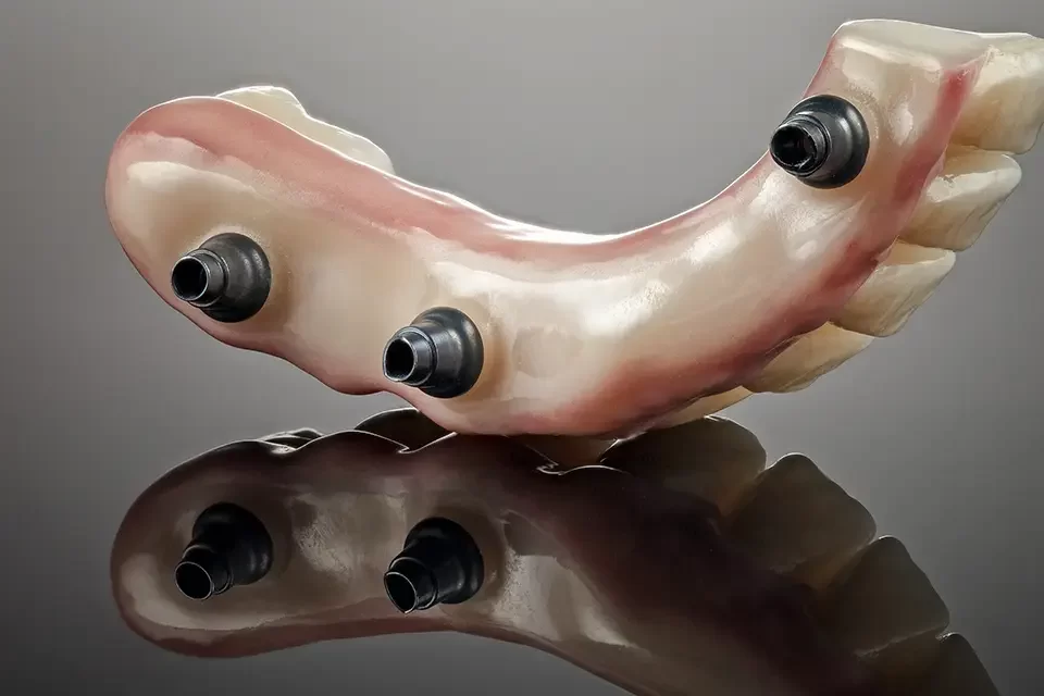 How Long Do BioHorizons Implants Last?