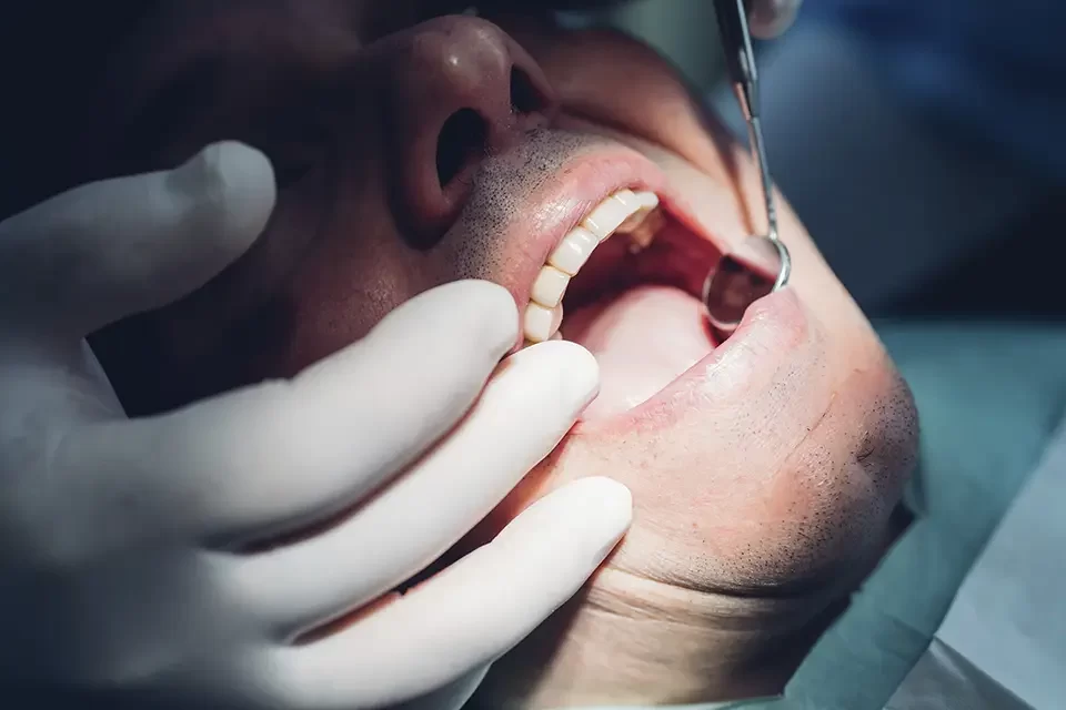 Exploring Causes: Why Do Teeth Crack Under Crowns?