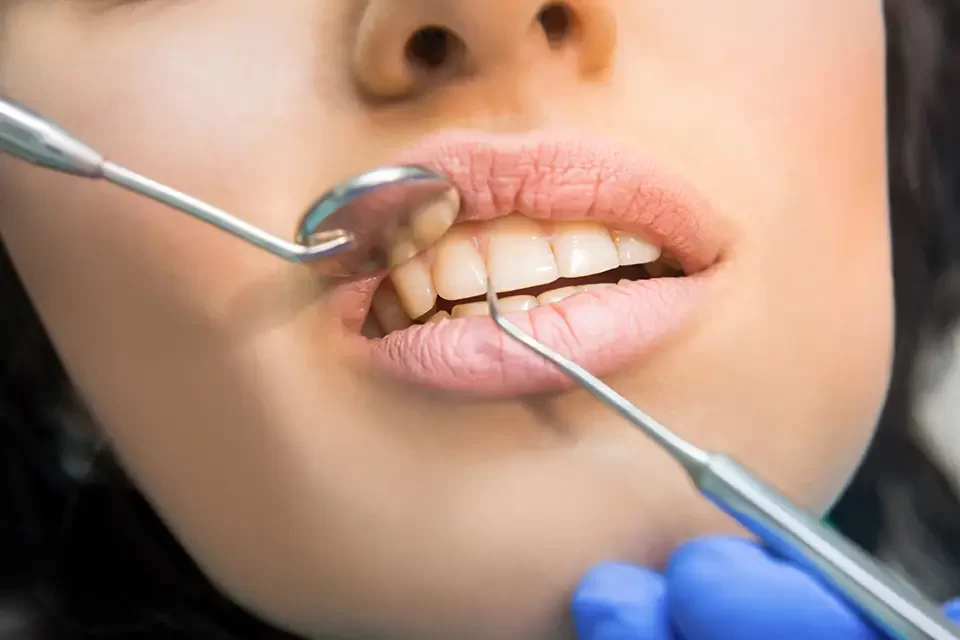 Tooth Filling Types