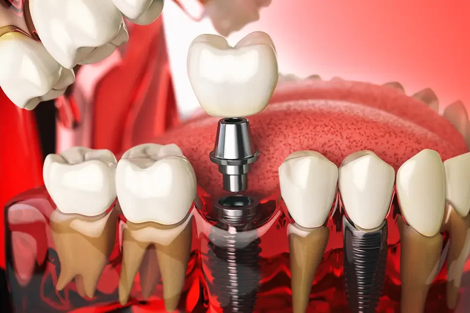 The Dental Implant Procedure