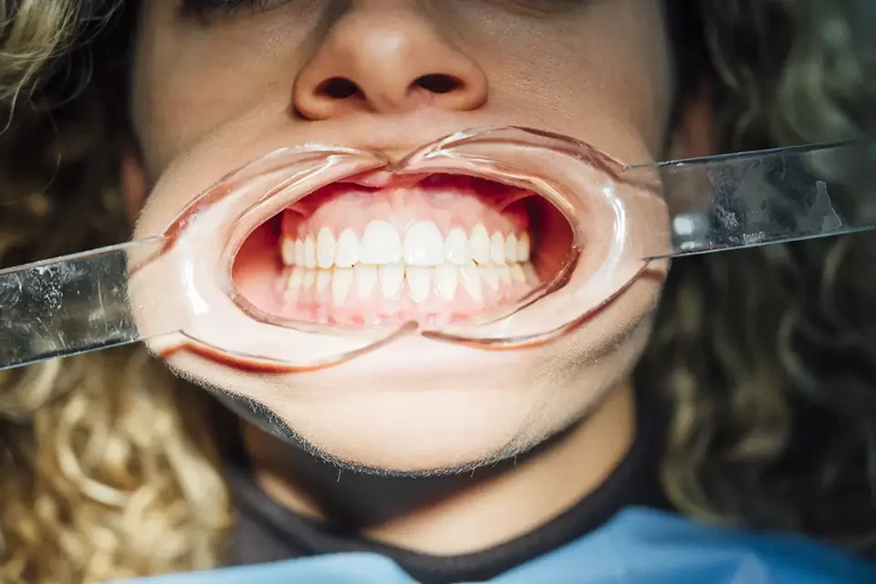 young-woman-getting-braces-put-on-teeth